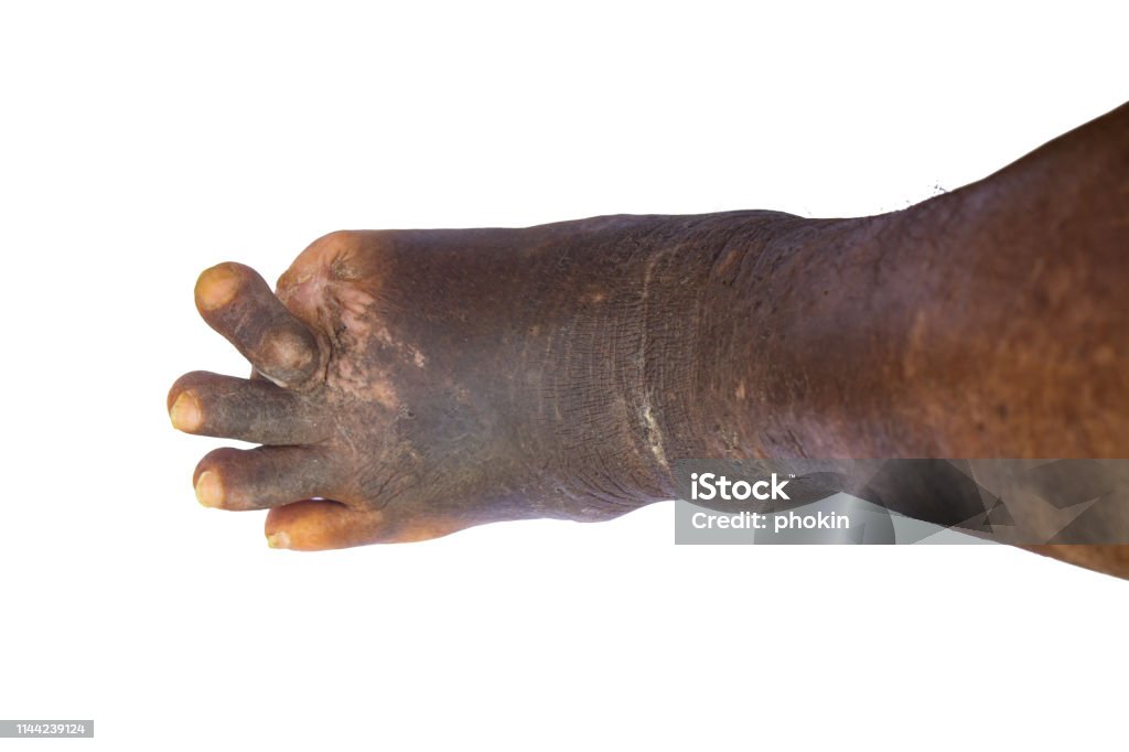 Symptoms of Leprosy