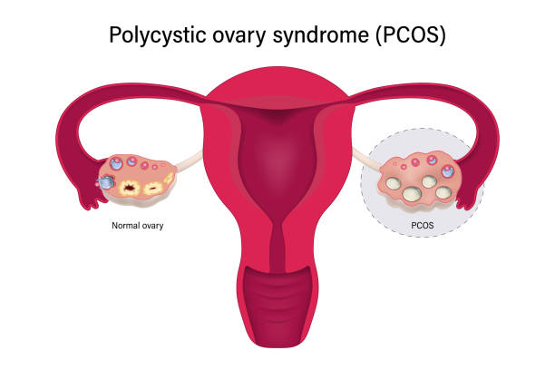 symptoms of PCOS