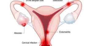 Pelvic Inflammatory Disease