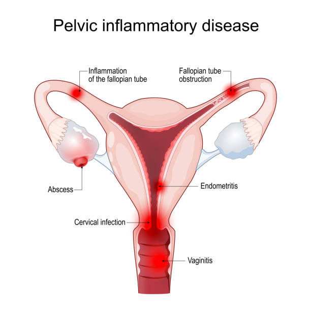 Pelvic Inflammatory Disease